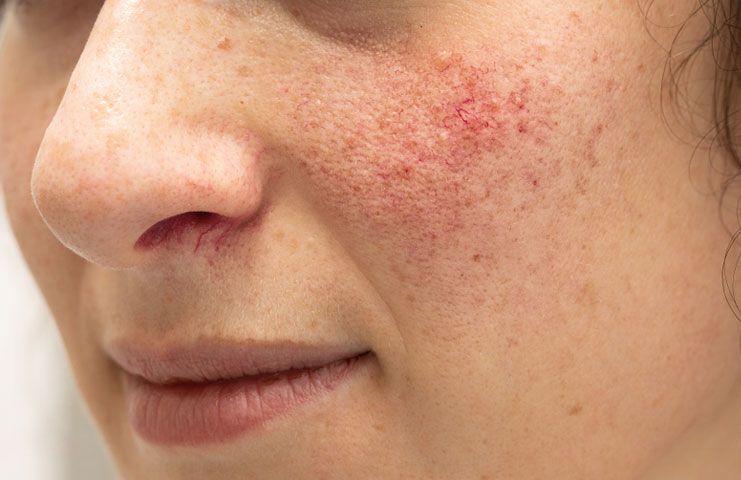 Can trigger rosacea