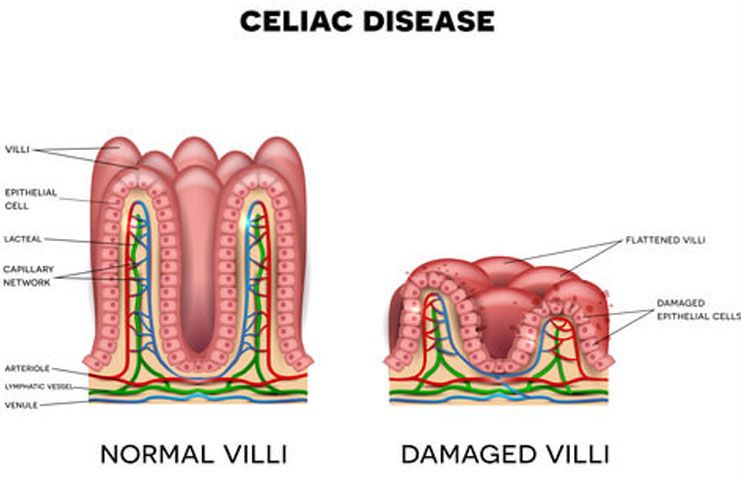 Celiac disease