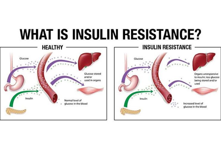 Insulin resistance