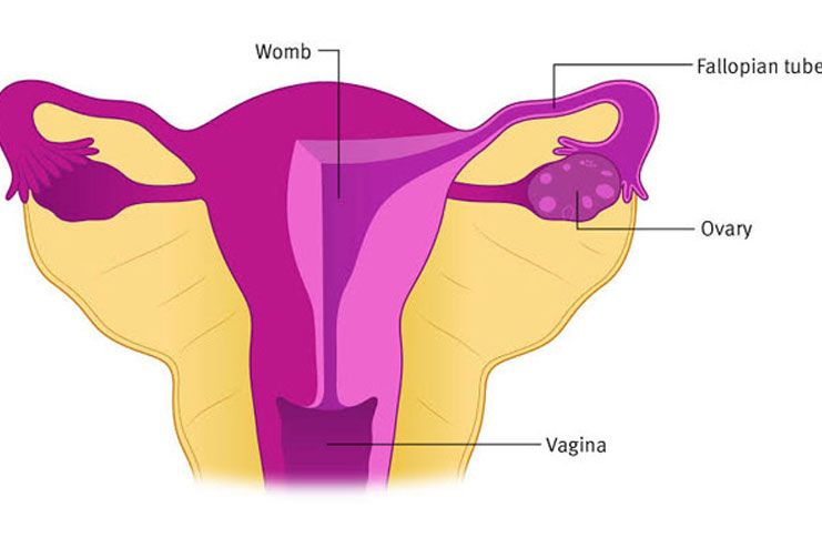 Ovarian Tumor