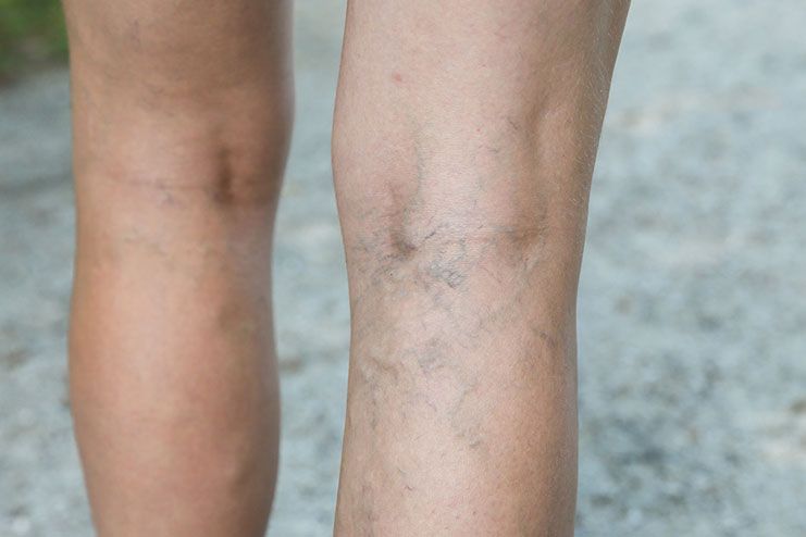 Risks of deep vein thrombosis