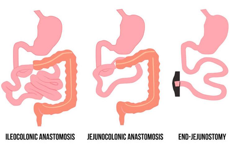 Short bowel syndrome