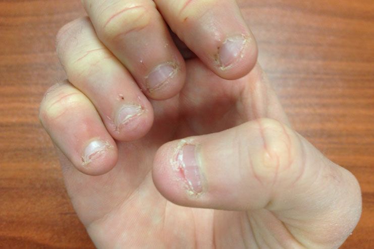 Short bitten nails