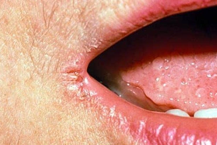 What are angular cheilitis