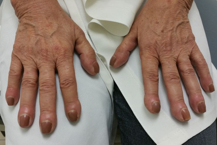 Nail Clubbing