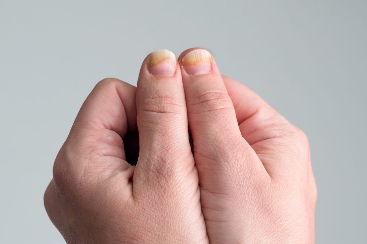 Ridges on the Nails