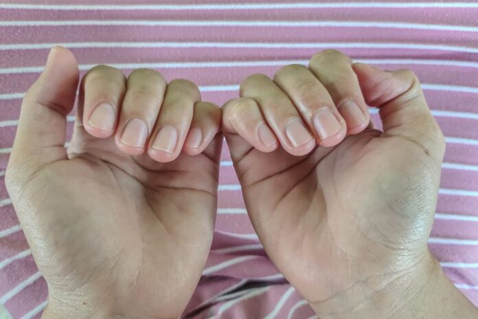 What Your Fingernails Reveal About Your Health What Your Fingernails Reveal About Your Health