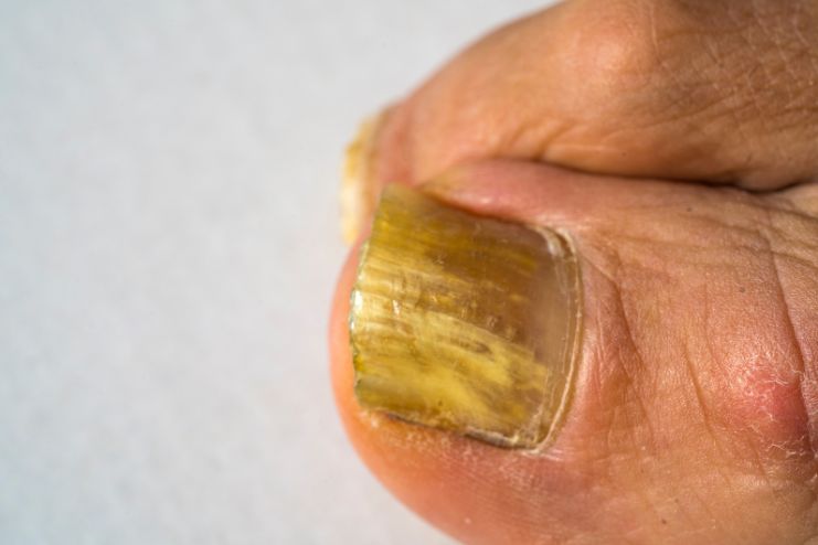 Yellow Fingernails