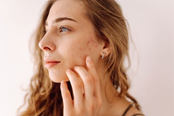 How to Use Castor Oil for Acne Safely