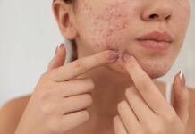 12 Ways to Use Castor Oil for Acne and Acne Scars Use Castor Oil for Acne and Acne Scars