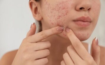 12 Ways to Use Castor Oil for Acne and Acne Scars Use Castor Oil for Acne and Acne Scars