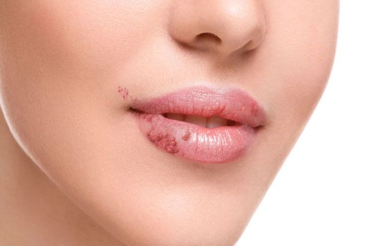 14 Ways To Get Rid Of Fordyce Spots On Lips – Get Soft And Supple Lips