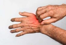 At Home Fungal Skin Infection Treatment – 10 Natural Remedies That Work At-Home-Fungal-Skin-Infection-Treatment