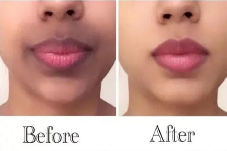 What Causes Dark Upper Lip