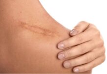 15 Natural Remedies For Old Scars – Fasten The Healing! 15 Natural Remedies For Old Scars