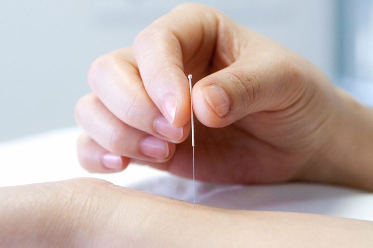 Acupuncture