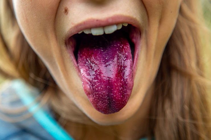 Black hairy tongue