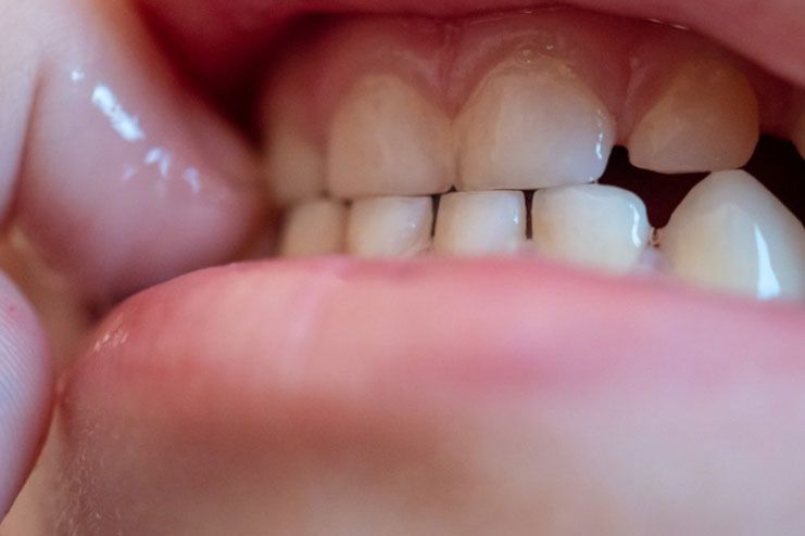 Consistent grinding of teeth Bruxism