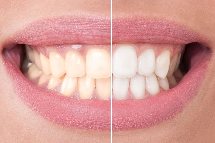 Excessive bleaching of teeth