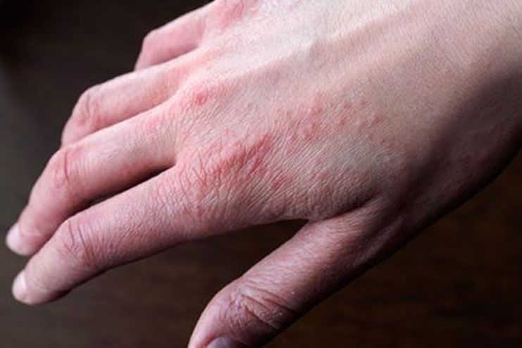 Hand eczema