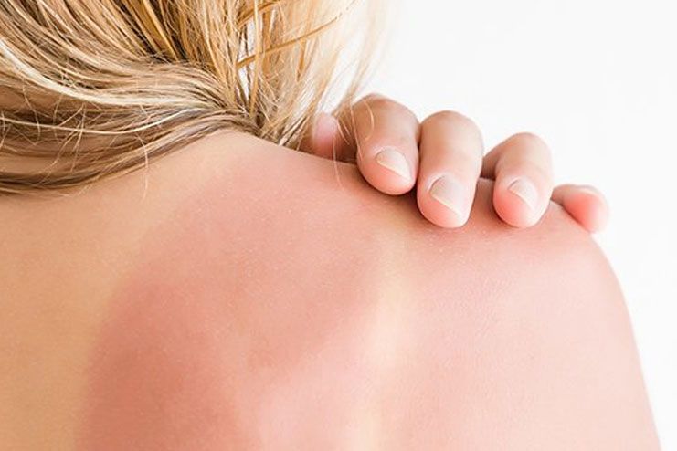 Possible risks of sunburn