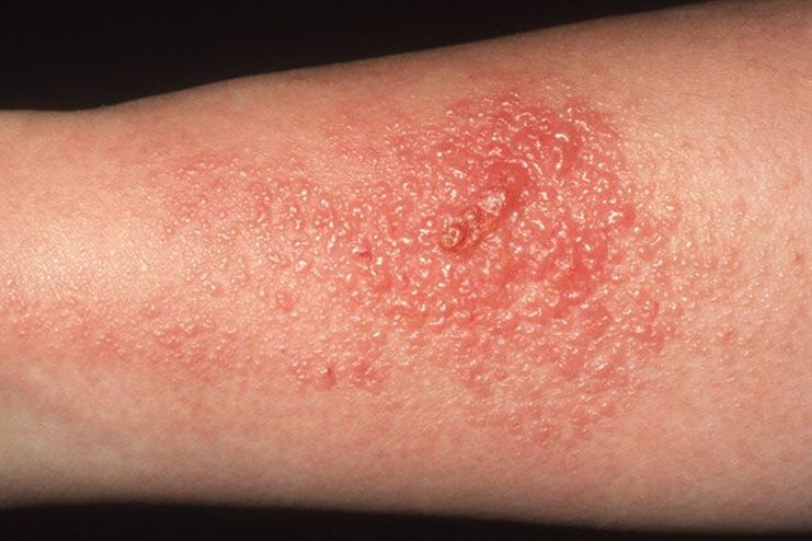 Skin or heat rashes