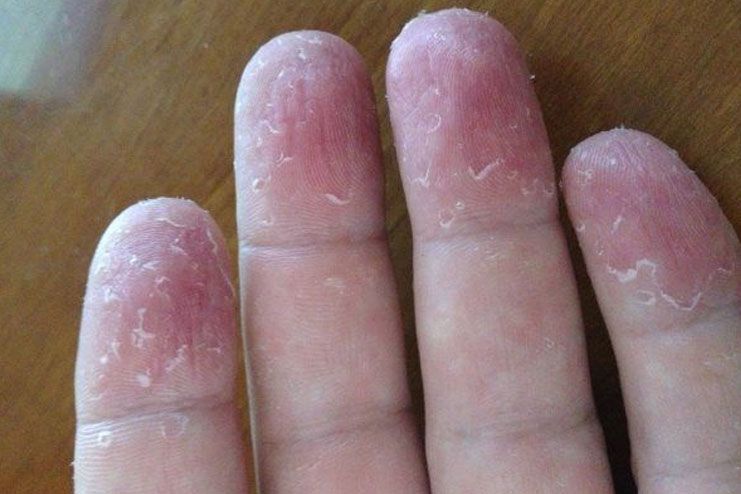 What is skin peeling on fingertips