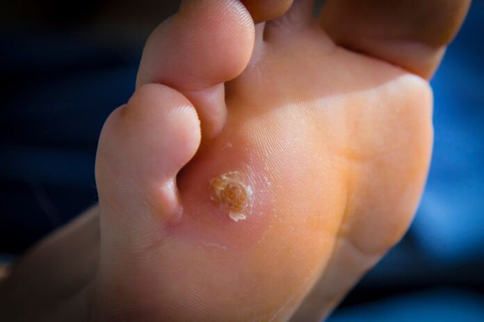 15 Natural Ways to Treat Corns and Calluses