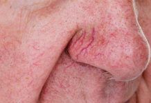14 Remedies for Spider Veins on Face That Work Remedies for spider veins | Healthspectra
