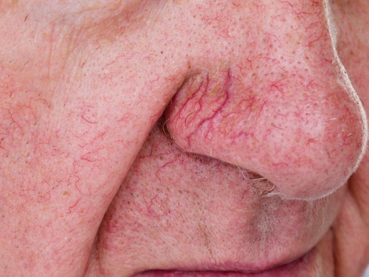 14 Remedies For Spider Veins On Face That Work