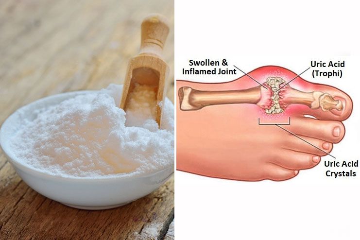 Baking Soda For Gout Pain – Is It Effective?