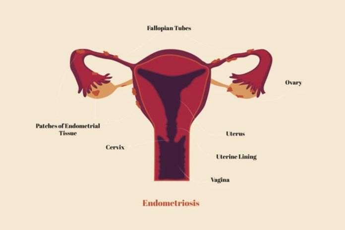 Endometriosis-Symptoms Causes Prevention and Treatment