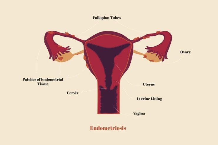 Endometriosis-Symptoms, Causes, Prevention and Treatment