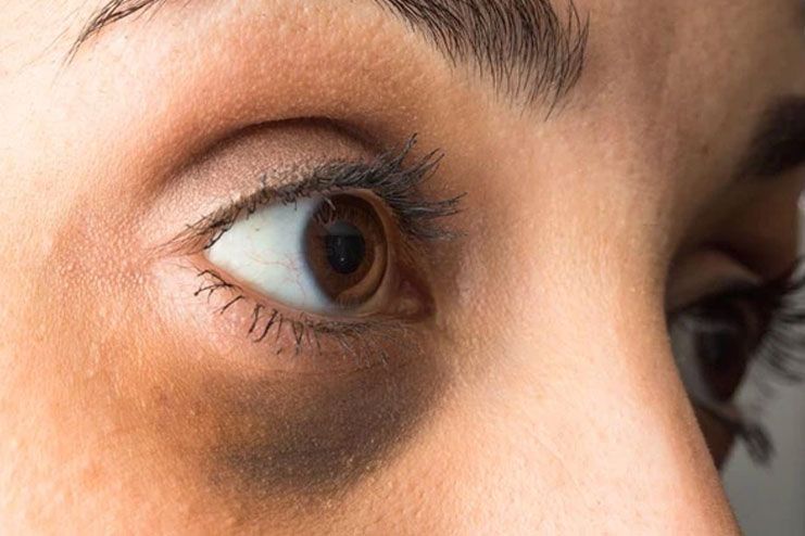 Everything You Should Know About Black Eye