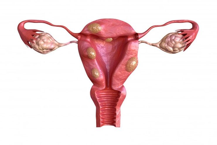 Risk Factors of Endometriosis