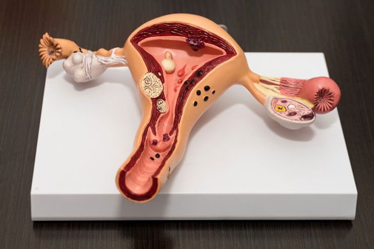 Stages of endometriosis