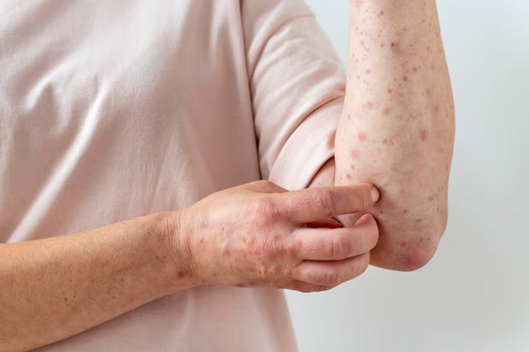 Eczema and Atopic Dermatitis