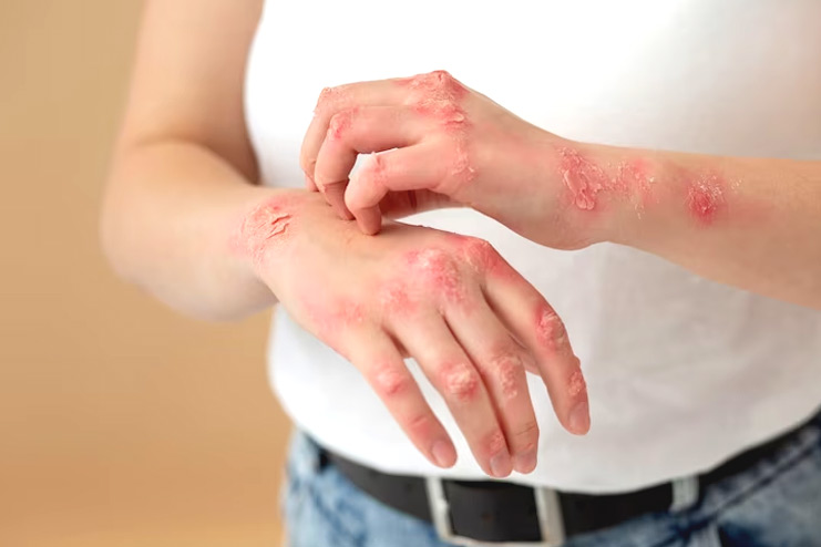 Stress and Psoriasis