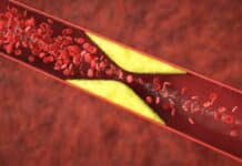 How to Manage Chronic Blood Clotting Disorders How to Manage Chronic Blood Clotting