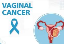 10 Causes of Vaginal Cancer 10-Causes-of-Vaginal-Cancer