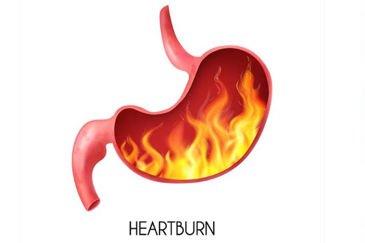 Acid Reflux or Heartburn Symptoms