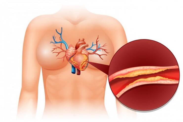 Heart Attack Symptoms