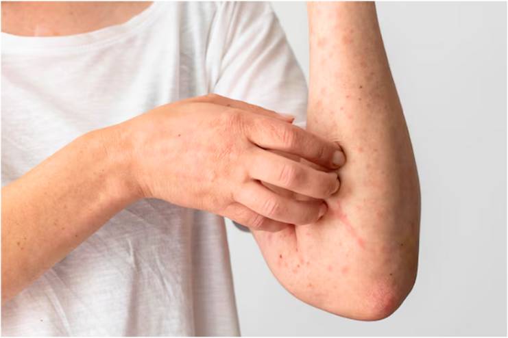 Skin Allergies