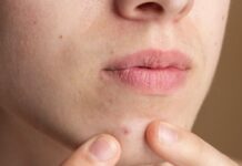 Acne Around the Mouth? Here’s What Your Skin Is Trying to Tell You Acne Around the Mouth