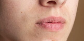 Acne Around the Mouth? Here’s What Your Skin Is Trying to Tell You Acne Around the Mouth