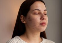 Acne Scars 101: How to Treat Different Types of Scars Effectively Acne Scars 101