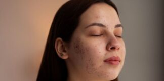 Acne Scars 101: How to Treat Different Types of Scars Effectively Acne Scars 101