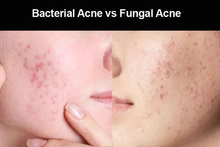 Differences Between Fungal and Bacterial Acne