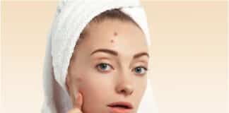 Skincare Mistakes That Make Acne Worse (And How to Avoid Them) Skincare Mistakes