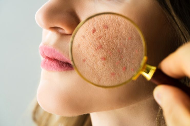 What Is Bacterial Acne
